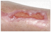 Epithelialising wound