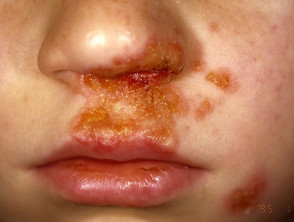 Child with Impetigo