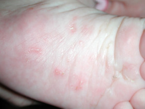 Child with Scabies