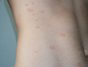 Child with Pityriasis Rosea