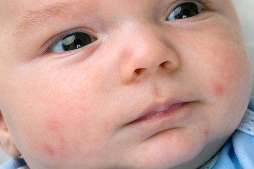 Child with Acne