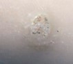 Deep Plantar Wart