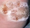 Mosaic Plantar Wart