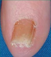 Fungal nail infection